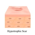Scars hypertrophic. The anatomical structure of the skin scar. Vector illustration on isolated background.