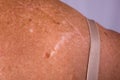 Scars on a lady's back from Skin Cancer Royalty Free Stock Photo