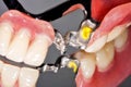 Dental prosthesis Royalty Free Stock Photo