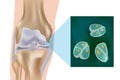 Schematic depiction of articular cartilage and chondrocytes of the joint surface. Structural and molecular changes Royalty Free Stock Photo