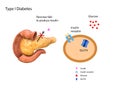 Schematic illustration of the pancreas and stomach in insulin levels and blood glucose. 3d 2d graphic, render