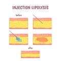 Scheme of cosmetic surgery