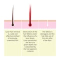 Scheme of laser hair removal. Description of the cosmetology procedure.