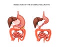 Scheme resection of the stomach Billroth 1