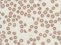 Schistocytes (red cell fragments) in peripheral blood.