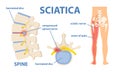 Sciatic nerve pain Royalty Free Stock Photo