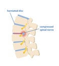 Sciatic nerve pinching concept