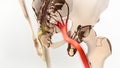 Sciatic Pinched Nerve Illustration