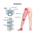 Sciatica areas of pain with anatomical location on leg outline diagram