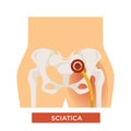 Sciatica bone disease sciatic back pain hip bone