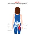 Sciatica.  Body of a patient woman with areas of pain from the back. Piriformis Royalty Free Stock Photo