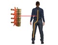 Sciatica pain, a symptom of disturbance in the nerve of the spine, reaches the leg and causes discomfort