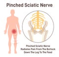 Sciatica. Pinched sciatic nerve causing pain and inflammation in pelvis