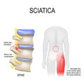 Sciatica. scheme with vertebrae, disks and nerves. Human body from back