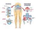 Sciatica vs piriformis medical muscle conditions comparison outline diagram