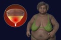 An overweight senior woman with a close-up view of her urinary bladder, 3D illustration