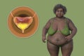 An overweight senior woman with a close-up view of her urinary bladder, 3D illustration