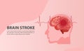 Human brain stroke illustration