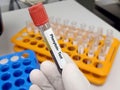 Scientist hold blood samples for Phenytoin test,