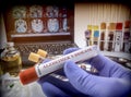 Scientist holds blood sample to investigate remedy against Alzheimer`s disease