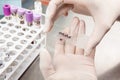 Scientist preparing a bone marrow smear in the laboratory. Blood smear