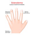 Scleroderma. autoimmune disease. Signs and symptom Royalty Free Stock Photo