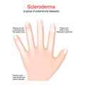 Scleroderma. autoimmune disease. Signs and symptom