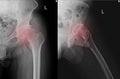 Sclerosis of articular surface of acetabular with marginal osteophytes. Osteoma at superior and inferior margins of femoral head.