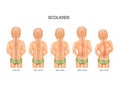 Scoliosis in children