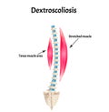 Scoliosis Dextroscoliosis. Spinal curvature, kyphosis, lordosis, scoliosis, arthrosis. Infographics. Vector illustration Royalty Free Stock Photo