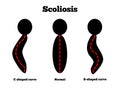 Scoliosis