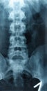 X-ray Scoliosis film x-ray lumbar spine AP