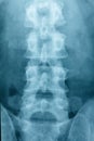 X-ray Scoliosis film x-ray lumbar spine AP Royalty Free Stock Photo