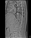 Scoliosis film x-ray lumbar spine