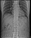 Scoliosis film x-ray lumbar spine Royalty Free Stock Photo
