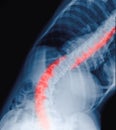 Scoliosis film x-ray show spinal bend in teenager patient.