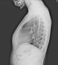 film x-ray show spinal bend in teenager patient. Scoliosis disease.