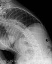 Scoliosis film x-ray show spinal bend