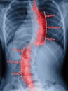 Scoliosis film x-ray spinal bend. Treatment concept