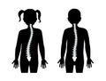 Scoliosis flat vector illustration