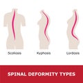 Scoliosis, lordosis and kyphosis