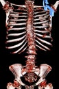 Scoliosis. Osteoporosis. CT-scan reconstruction