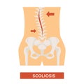 Scoliosis spine curvature skeleton bone disease vector illustration