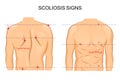 Scoliosis of the spine. signs