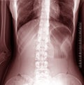 Scoliosis x-ray Royalty Free Stock Photo