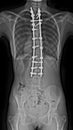 Scoliosis X-ray Royalty Free Stock Photo