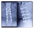 Scoliosis, X-ray