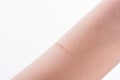 Scratch scar in hand