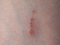 scratch scar on arm