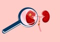 Scrutiny Kidney stone with magnifying glass.Nephrology.Pyelonephritis and renal failure disease.